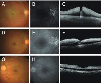 Figure 2. An optical coherence tomography image of an eye with  central retinal artery occlusion