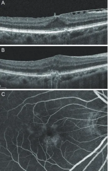 Table 4. Progression of degenerated macular changes Surgery  group Control group p-value * Number of eyes 41 34 CNV development 1/41 0/34 1.00