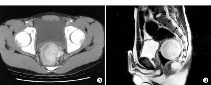 Fig.  2.  (A)  A  gross  finding  showing  a  submucosal  tumor  with  mucosal  uleration,  measuring  6×6×5.8  cm  size,  located  lower  rectum
