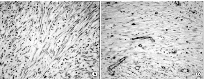 Fig.  4.  (A)  The  tumor  cell  are  diffuse  positive  staining  for  c-kit  protein  but    (B)  negative  staining  for  CD34  (immunohistochemical  stain, 