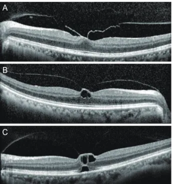 Figure 1. Cases of optical coherence tomography scan grading in  vitreomacular traction syndrome