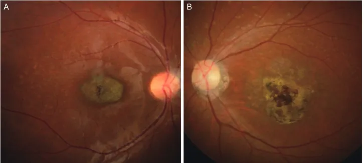 Figure 1. Representative cases showing distribution of pathologic lesions (A) confined within the temporal arcade and (B) extending outward to  the temporal arcade (B).