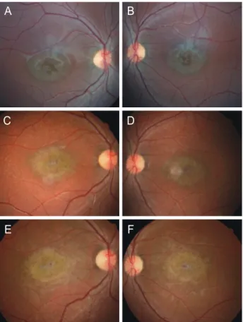 Figure 3. A representative case showing initial and final findings of a  patient diagnosed with Stargardt disease