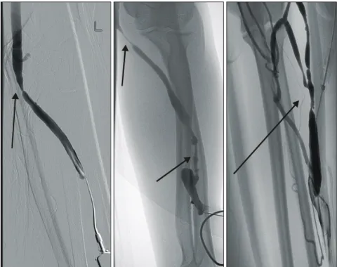 Fig.  2.  The  fistulographic  finding  of  three  flow  rate  decrement  patients   repre-sented  draining  venous  stenosis.