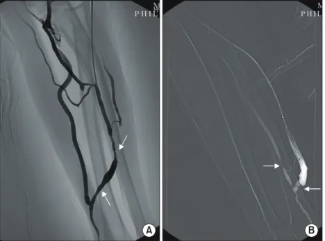 Fig.  3.  The  trend  of  calculated  flow  rate  (Q F )  in  3  draining  venous  stenosis  patients