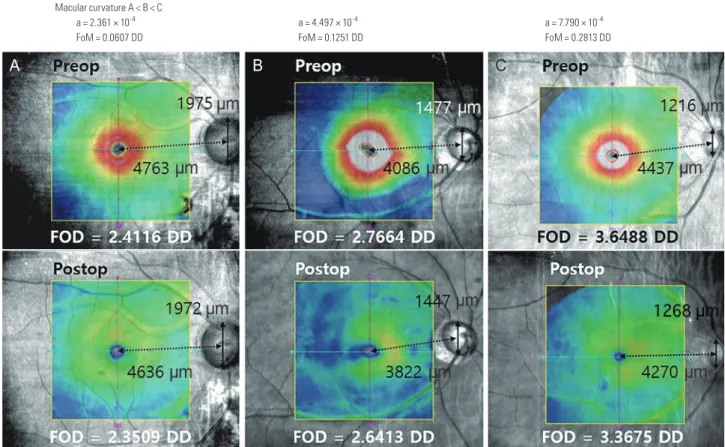 Figure 3. Schematic drawings representing traction force changes according to macular curvature after macular hole surgery
