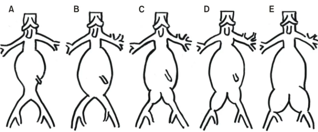 Fig.  1.  Classification  of  AAA.  (A)  AAA  without  involvement  of  distal  aorta,  (B)  AAA  with  involvement  of  distal  aorta  but  without  involvment  of  common  iliac  artery,  (C)  AAA  with  involvement  of  common  iliac  artery  and  capab