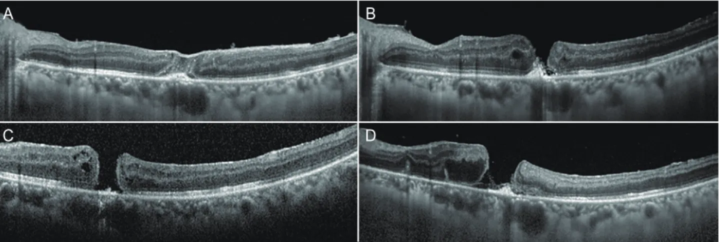 Figure 4. Eight months after HVSO injection. (A) Fundus examina- examina-tion revealed a well-closed macular hole, and (B) OCT demonstrated  complete closure of the macular hole