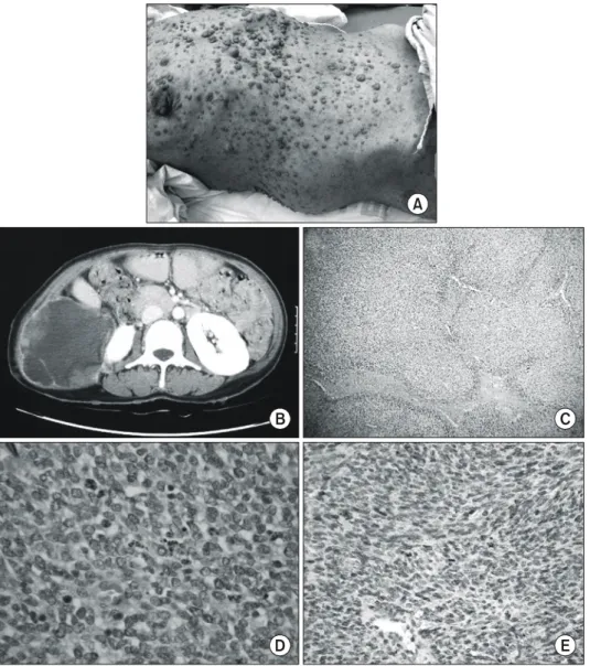 Fig.  1.  Clinicopathologic  findings  of  case  1.  (A)  Patient  have  multiple  neurofibromas  of  variable  size  and  cafe-au-lait  spots