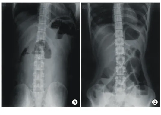 Fig.  3.  Operative  field.  The  diverticular  tip  and  small  bowel  mesentery  develop  an  adhesive  band,  which  obstructs  distal  ileum  with  the  proximal  part  severely  distended.