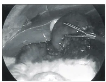 Fig.  3.  Operative  finding  shows  strangulated  small  bowel  loop  on  subhepatic  area