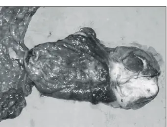 Fig.  4.  The  compact  tumor  is  composed  of  the  area  of  metastatic  squamous  cell  carcinoma,  moderately  differentiated  of  duodenum  extending  to  pyloric  ring  and  involving   om-entum  (A:  H&amp;E,  ×40),  (B:  H&amp;E,  ×100)