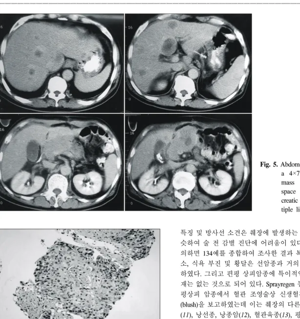 Fig.  5.  Abdomen  CT  scan  shows  a  4×7  cm  sized  large  mass  in  peripancreatic  space  after  partial   pan-creatic  resection  and   mul-tiple  liver  metastasis.