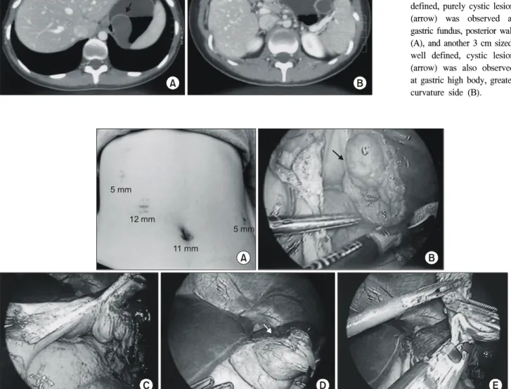 Fig.  3.  Operation  findings.  In  the  operation,  four  laparoscopic  ports  were  introduced  as  the  photograph  (A)