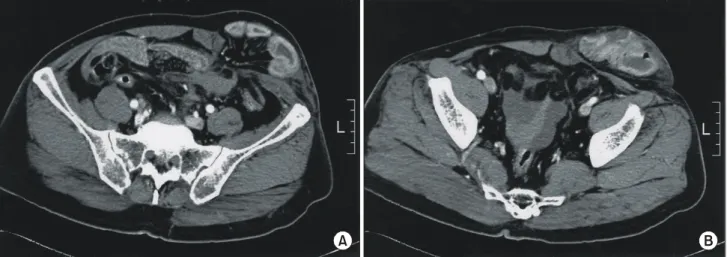 Fig.  3.  Operative  finding  showes  herniation  of  perforated  small  bowel  and  mesentery  along  the  lateral  border  of  left  rectus  muscle.
