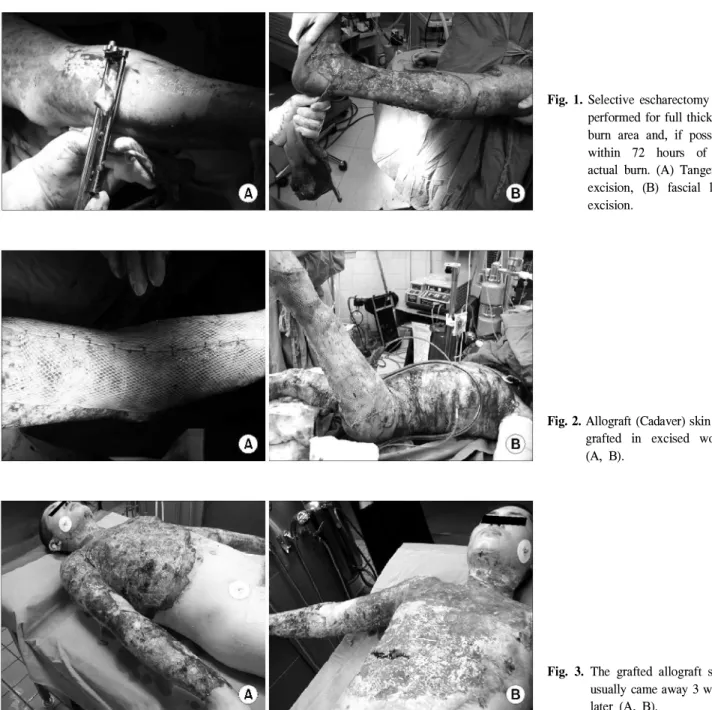 Fig. 2. Allograft (Cadaver) skin was grafted in excised wound (A, B).