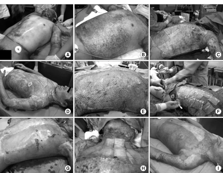 Fig. 7. (A) 37 years old patient with 51%TBSA* flame burned, (B) Post-burn 4th day (infection progression), (C) The full thickness burn wound was excised and covered with cadaver skin (35%TBSA*), (D) Grafted cadaver skins were came off 21 days later, (E, F