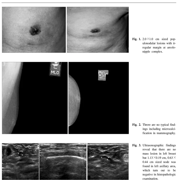 Fig. 2. Threre are no typical find- find-ings including  microcalci-fication in mammography.