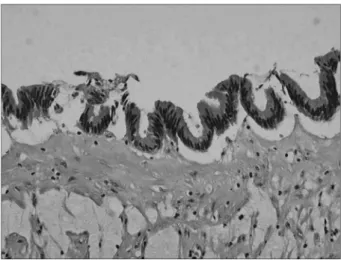 Fig. 4. Pathologic specimen shows the inflamed appendix with mucinous cystadenoma (H&amp;E, ×500).