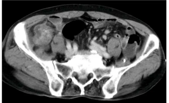 Fig. 6. Computed tomography shows the whirling of ascending colon and mesocolon, which indicated the intussusception