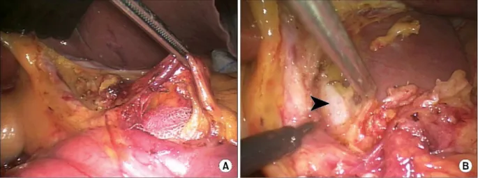Fig. 3. Step III: The right gastric artery and the proper hepatic artery were exposed after dissection of no