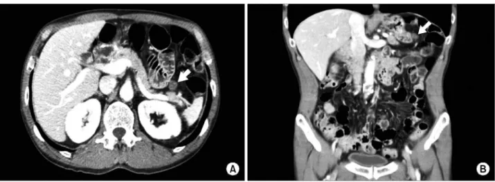 Fig. 1. Follow-up abdominal CT. 1.6 cm nodular lesion (marked with arrow) between efferent jejunal loop and pancreas tail which suggested a suspicious metastatic lymph node most likely or postoperative inflammatory change less likey