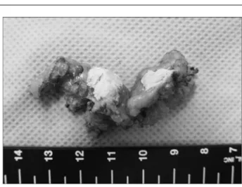 Fig. 5. Gross finding of specimen. A 1.2 cm sized nodular lesion was examined and there were only fat necrosis with a foreign body (suture) granuloma and 2 lymph nodes without metastatic tumors.