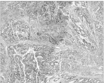 Fig. 3. Immunoperoxidase staining rectal cancer with Mab Ki-67 (×100).