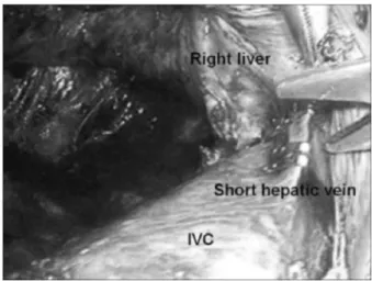 Fig. 1. The position of the trocars. Trocar E was inserted only in the first patient.