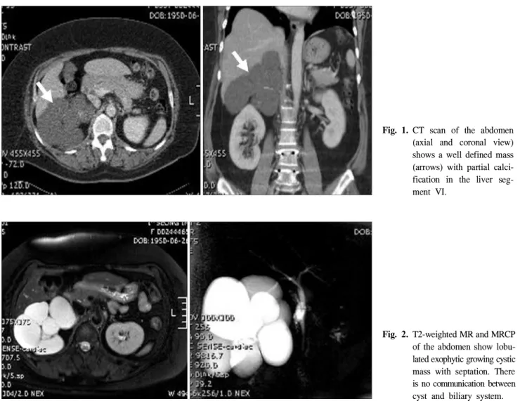 Fig. 2. T2-weighted MR and MRCP of the abdomen show  lobu-lated exophytic growing cystic mass with septation