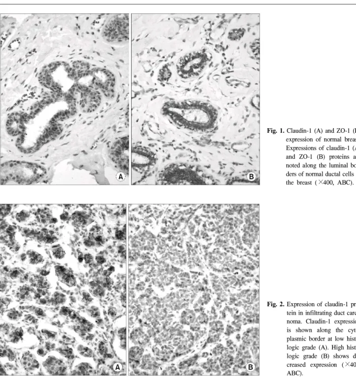 Fig. 2. Expression of claudin-1 pro- pro-tein in infiltrating duct  carci-noma. Claudin-1 expression is shown along the  cyto-plasmic border at low  logic grade (A)