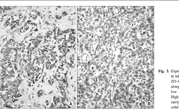 Table 2. Correlation of expression of Claudin-1 and ZO-1 proteins in the breast cancer