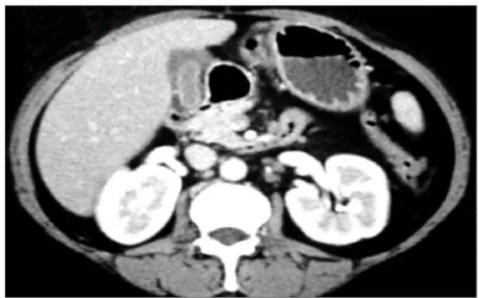 Fig. 3. DISIDA scan shows no main duct bile leakage of the patient.