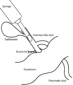 Fig.  1.  After  suture  ligation  of  distal  common  bile  duct,  5  ml  of  collagenase  solution  was  injected  through  gall  bladder.