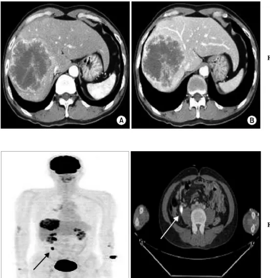 Fig. 1. (A) The abdominal CT re- re-vealed a 9 cm sized  malig-nant appearing peripheral enhancing mass in the  rig-ht lobe of the liver