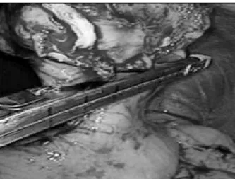 Fig.  1.  Preoperative  abdominal  CT  scan  showed  solid  mass  in  gas- gas-trohepatic  space,  gastric  GIST.