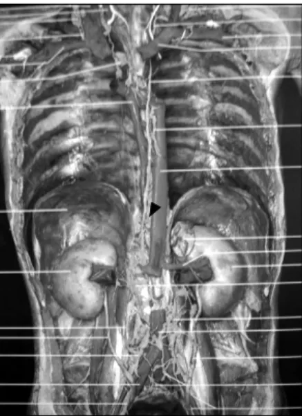 Fig.  2.  Anatomy  of  thoracic  duct.  Thoracic  duct  was  indicated  by  black  arrow  head.