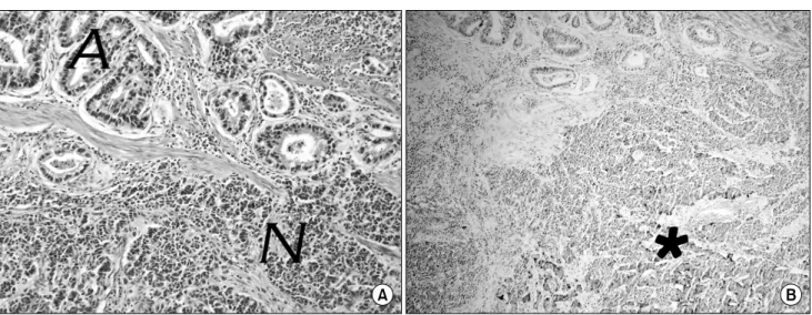 Fig.  3.  Higher  power  view  demonstrates  the  close  apposition  of  the  adenocarcinoma  (A)  and  poorly  differentiated  endocrine  component  (N)  but  not  intermingling  (H&amp;E  stain,  ×200)