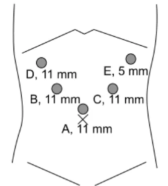 Fig.  1.  Abdominal  computed  tomography  showing  a  2  cm  sized  single  tumor  located  in  Spiegel  lobe  of  the  caudate  lobe