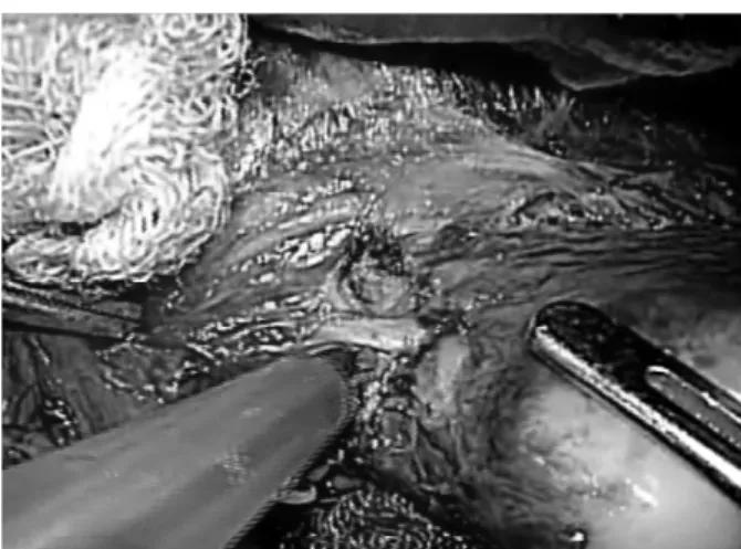 Fig.  6.  Laparoscopic  view  after  liver  resection  of  the  caudate  lobe. 