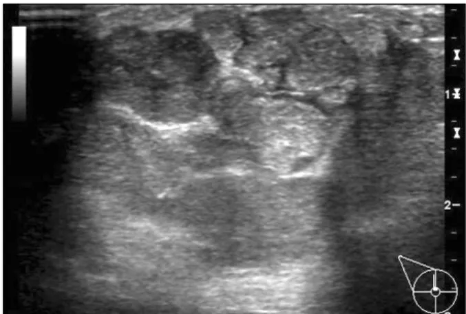 Fig.  1.  Breast  ultrasonogram  showing  a  4.5×4.5  cm  sized,  multi- multi-lobulated,  hypoechoic  lesion  in  the  right  breast.