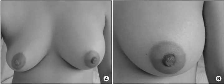 Fig.  1.  Breast  images.  (A)  A  39-year-old  women  presented  with  a  diffuse  enlargement  in  the  left  breast