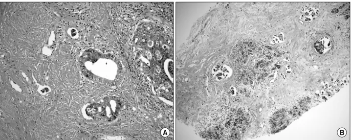 Fig. 3. Microscopic  findings  of  cervical  cancer  and  breast  metastasis.  (A)  Photomicrograph  of  cervical  cancer  which  was  obtained  in  operation  showing  glandular  and  cribriform  pattern  of  malignant  glandular  epithelial  cells  (H&am