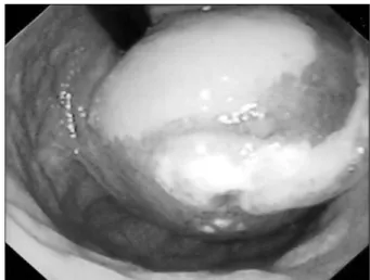 Fig.  1.  Endoscopic  view  of  the  gastric  fundus  revealed  a  large,  pro- pro-truding  submucosal  lesion  in  the  greater  curvature  of  the  stomach