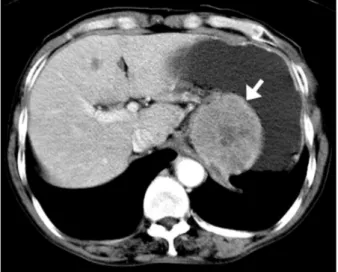 Fig.  2.  Abdominal  computed  tomography  demonstrated  a  well-de- well-de-fined  low-density  mass  (8  cm  in  diameter)  that  was  located  in  the  fundus  of  the  stomach  (arrow)  and  had  central  necrosis.