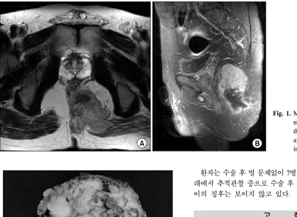Fig.  1.  MRI  shows  a  heterogeneous  mass  with  central  necrosis  in  the  ischiorectal  fossa  on  T2  axial  &amp;  Enhanced  T1  Lateral  image.