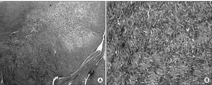 Fig.  3.  The  tumor  shows  increased  celluarity  (A)  &amp;  architecture  consisted  of  spindle-shaped  cells  and  keloidal-type  collagen  deposition  (B)  (H&amp;E  stain,  ×100,  ×400).