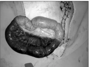 Fig.  1.  A  25  cm  segment  of  small  intestine  became  strangulated  rapidly  after  herniation  on  the  drain  site  located  at  the  right  lower  abdomen