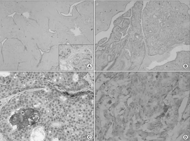 Fig.  1.  Grade  of  positivity  of  Galectin  3  in  benign  and  malig- malig-nant  breast  neoplasm