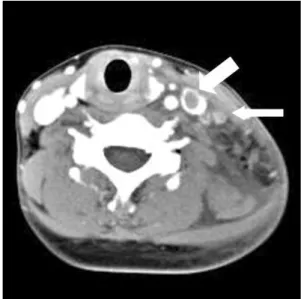 Fig. 1. Neck  CT  scan.  It  shows  that  the  left  internal  jugular  vein  (wide  arrow)  is  not  enhanced  due  to  thrombus  and  is  not  compressed  by  enlarged  cervical  lymph  nodes